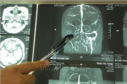 Cảnh báo một số bệnh lý về não từ dấu hiệu thường xuyên chóng mặt, đau đầu